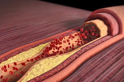 image 甘油三酯高