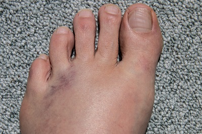 糖尿病脚足病肿胀症状